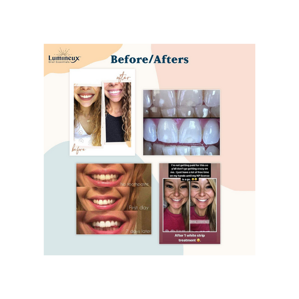 Lumineux Teeth Whitening Strips by Oral Essentials - 21